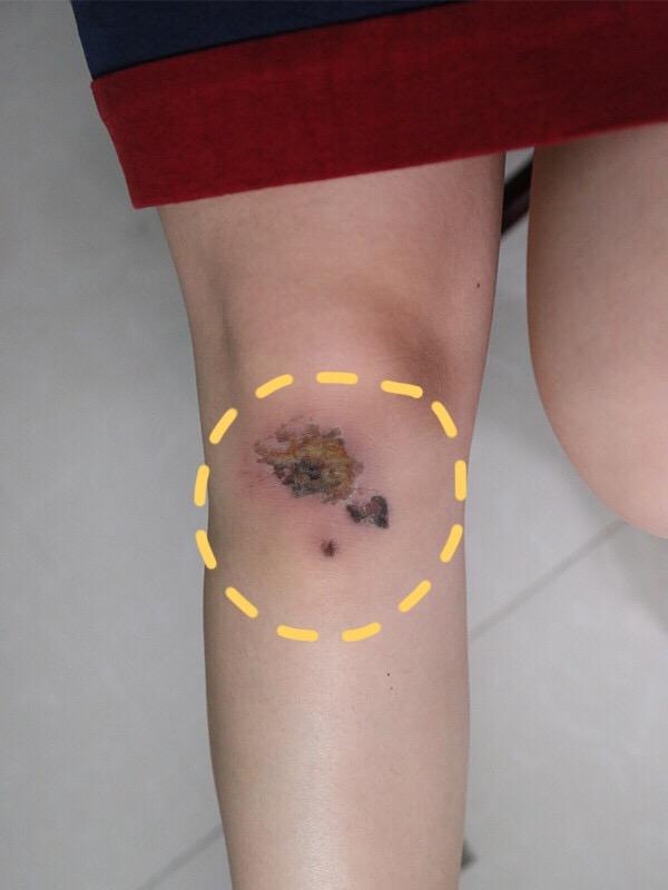 (微笑脸)去医院处理完了以后就包上了,结痂的时候特别的