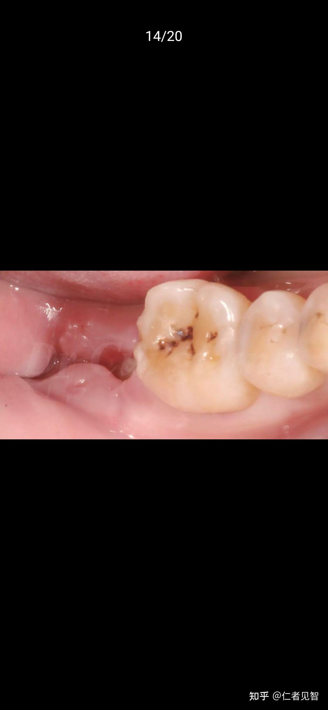 为什么拔牙后牙槽不会萎缩