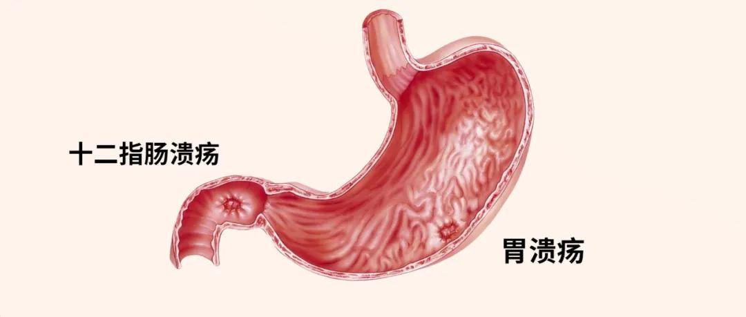 长期胃痛是什么问题胃溃疡会演变成胃癌吗