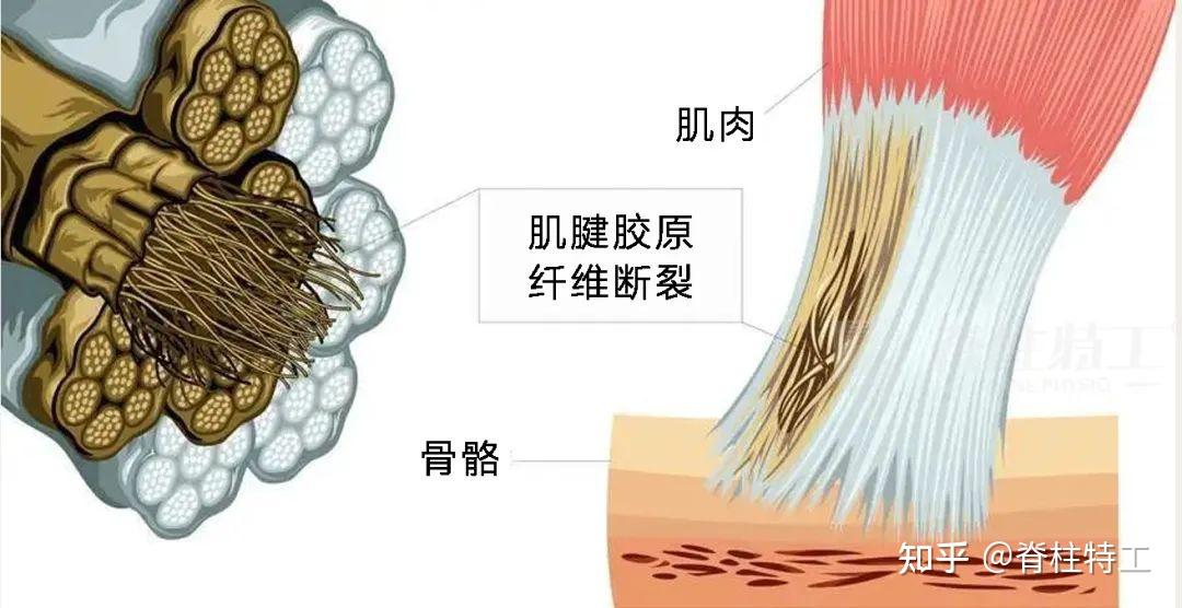 肌肉纤维断裂图片图片