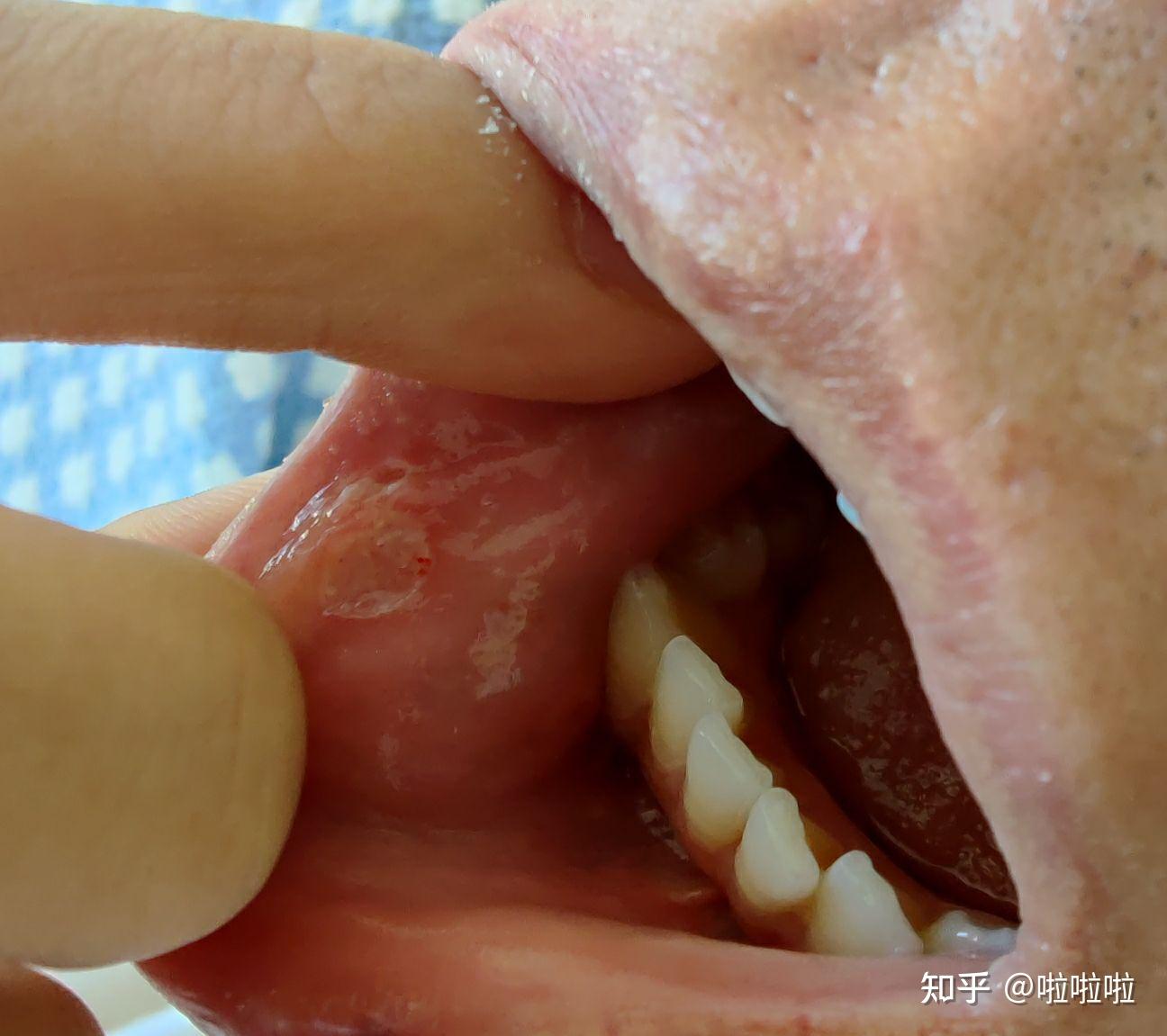 一位白塞病强直性脊柱炎患者的自述