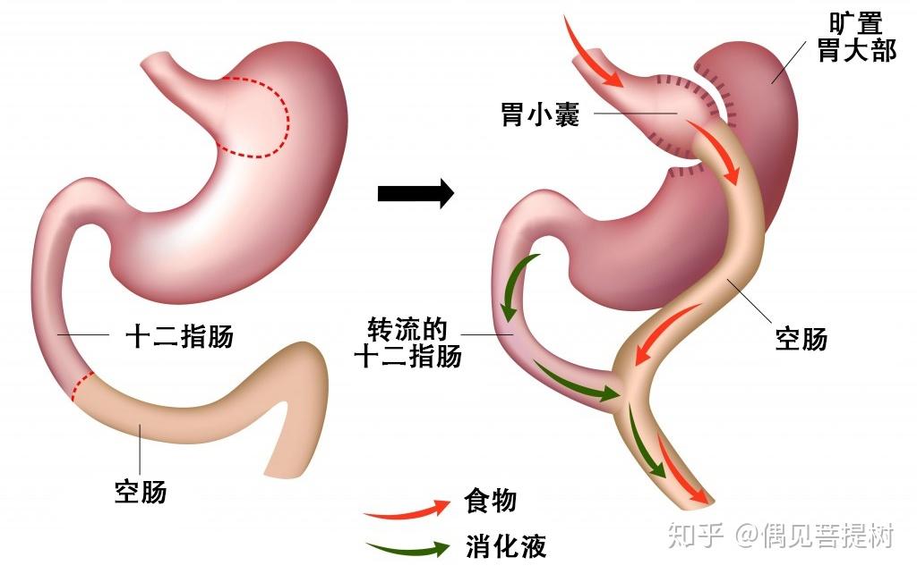 減重手術還能治糖尿病是真的嗎