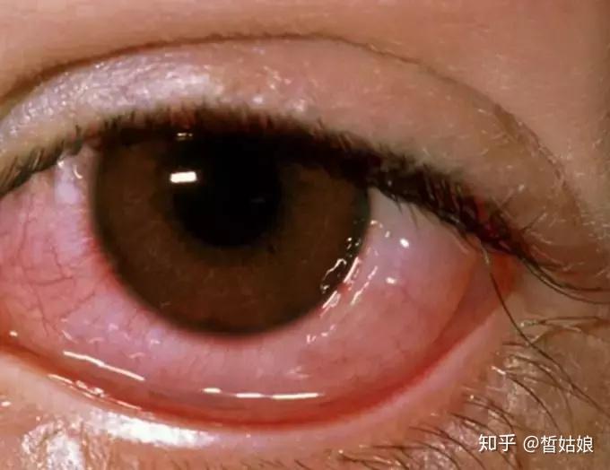 角膜炎VS结膜炎,都是眼睛红肿一字不同天差地别 - 知乎