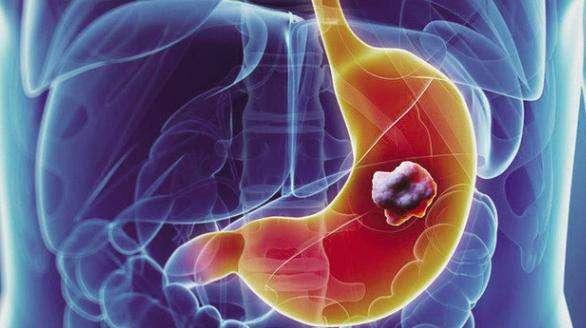 胃癌晚期症状能活多久图片