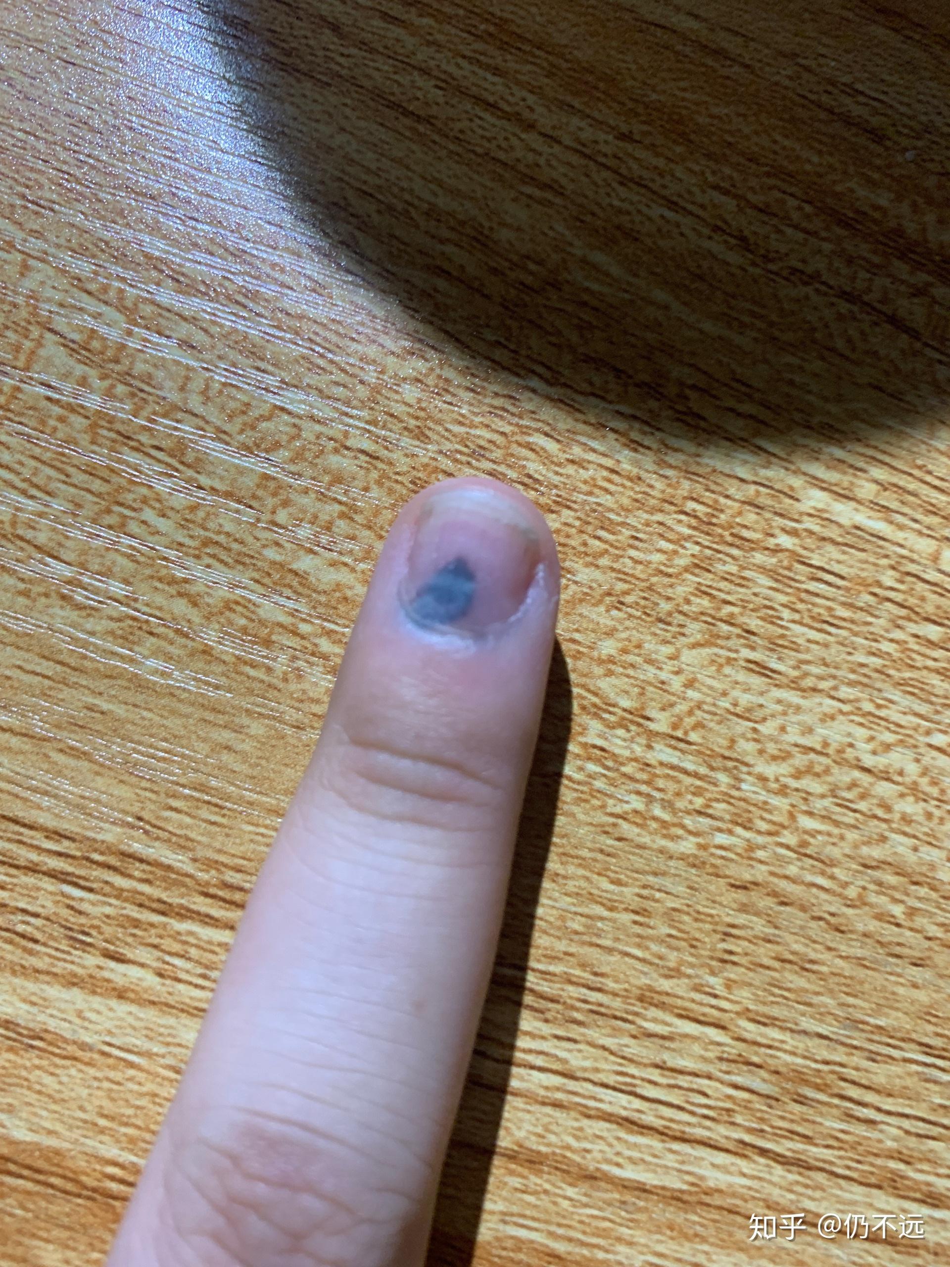 手指被门夹了,然后指甲里面四分之一有淤血,都两个月了还没好,怎么办?