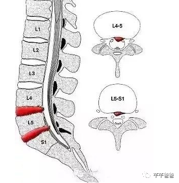 程序员腰突经历分享(中) 程序员腰突经历分享(中)