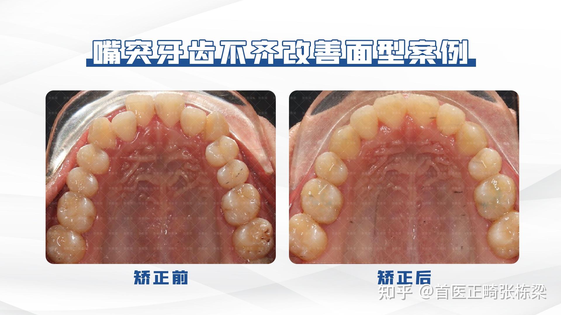 牙齒正畸 | 牙齒矯正不只排齊牙齒 還可以解除嘴凸,