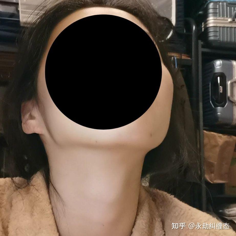 我这是颧弓外扩加高颧骨吗我才十六岁该怎么办呢