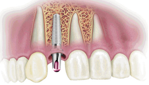 深圳德国camlog种植体好用吗?