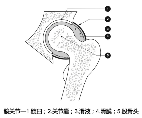 髋关节滑膜炎科普