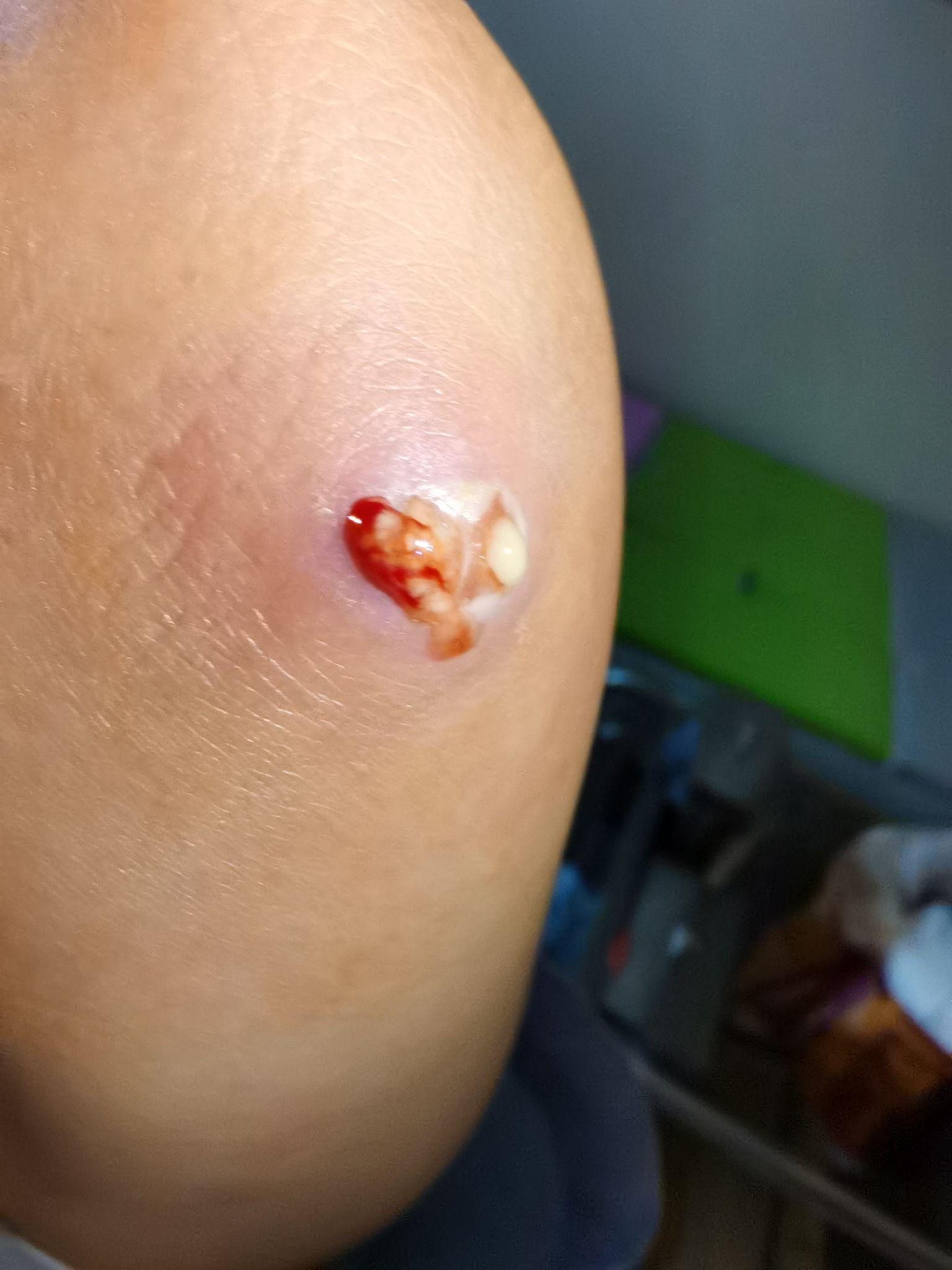 火疖子特效药 知乎