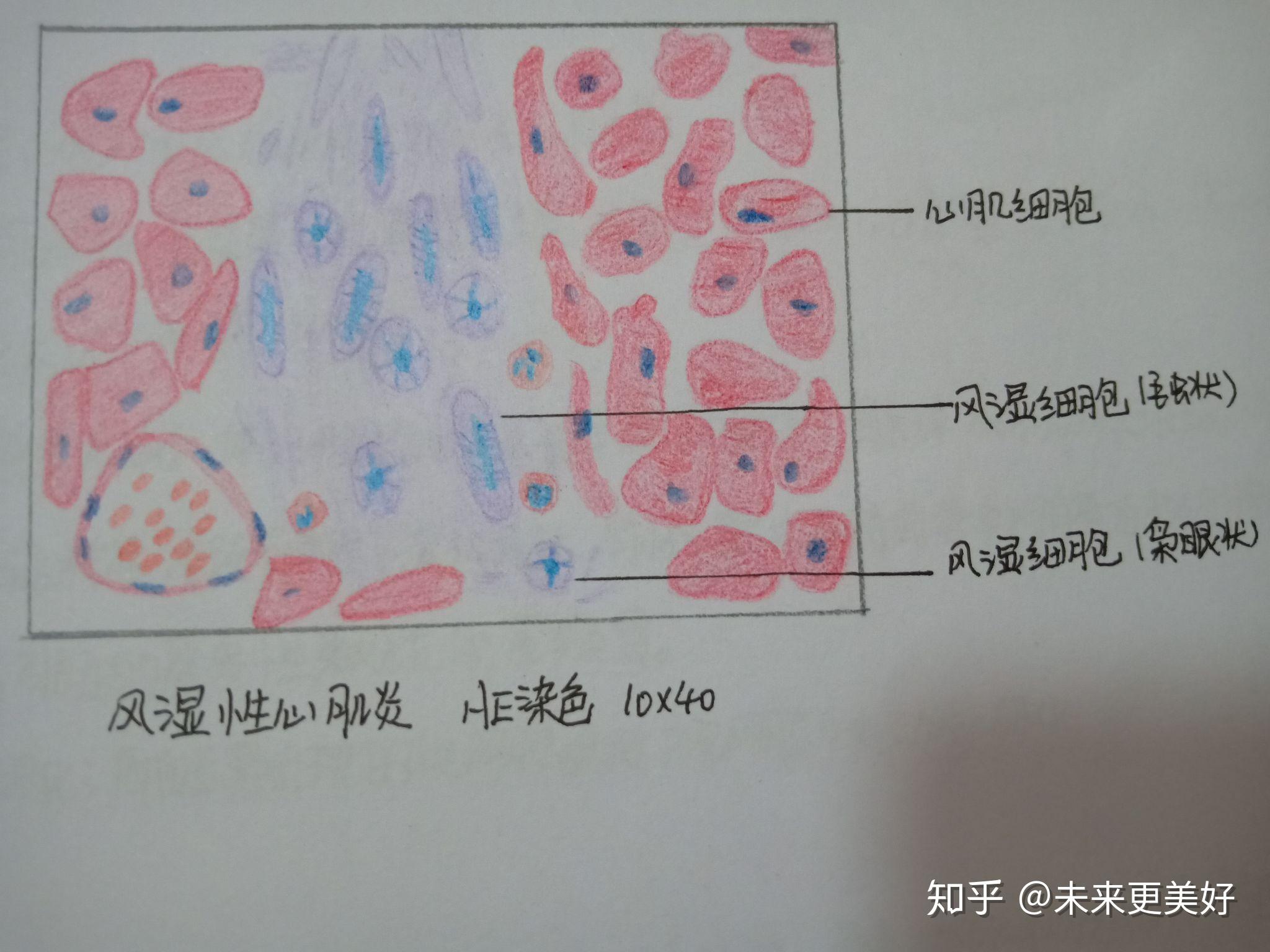 病理學切片紅藍鉛筆手繪圖