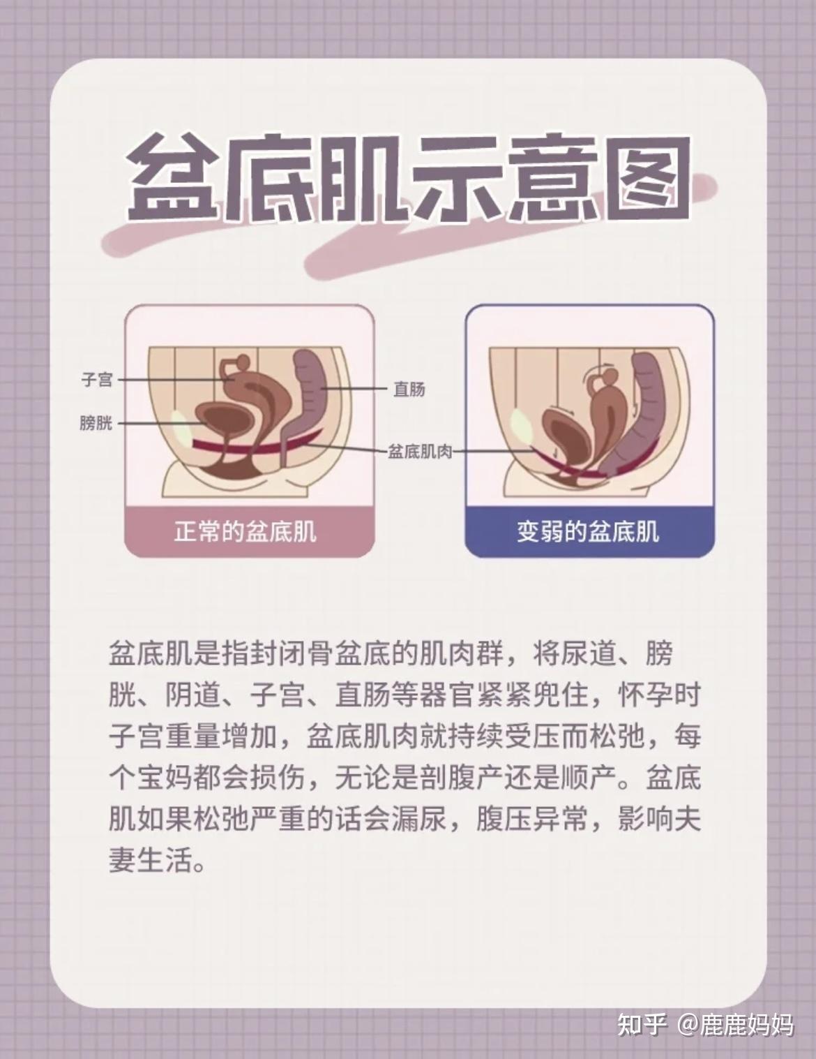 产后盆底肌修复全攻略