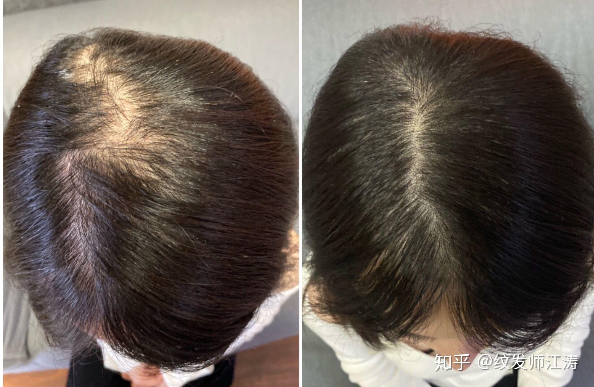 这样的头发算不算太秃,怎么办才能不秃?天生发量少遗传的…也不怎么脱发,就是秃? - 知乎