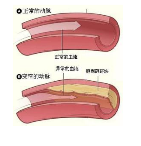 血管老化就是”动脉硬化”,称为沉默的杀手 - 知乎