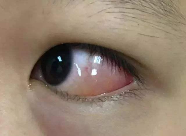 双眼皮术后为什么会出现结膜水肿?