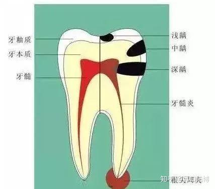 牙齿有个小黑点 需要补牙吗 知乎