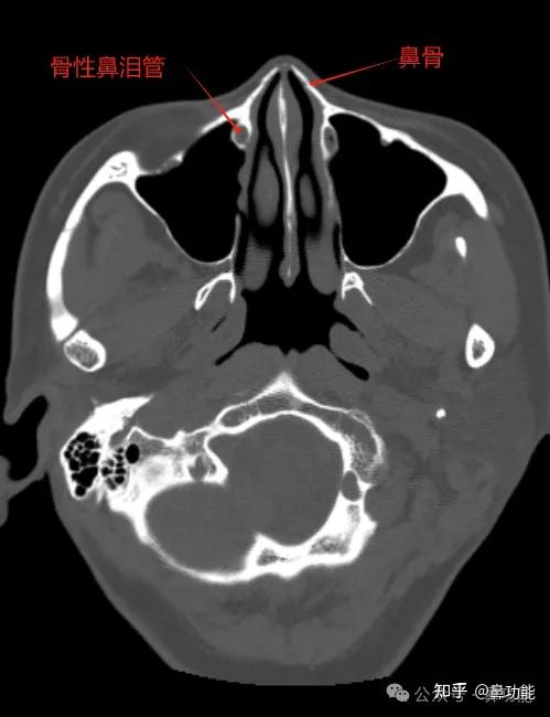 鼻窦 CT 各部位名称解析与鼻腔解剖基础知识 - 知乎