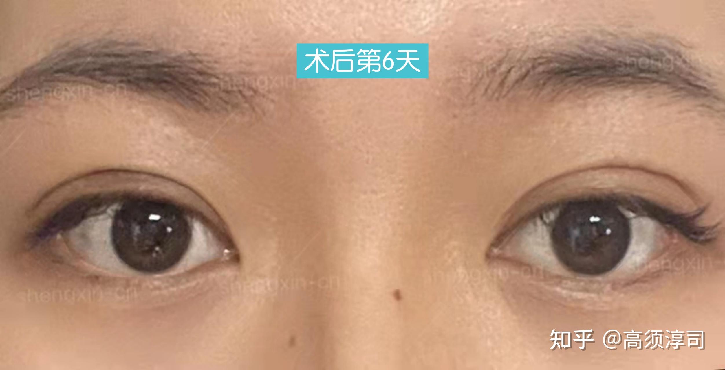 韩式微创双眼皮恢复过程 - 知乎