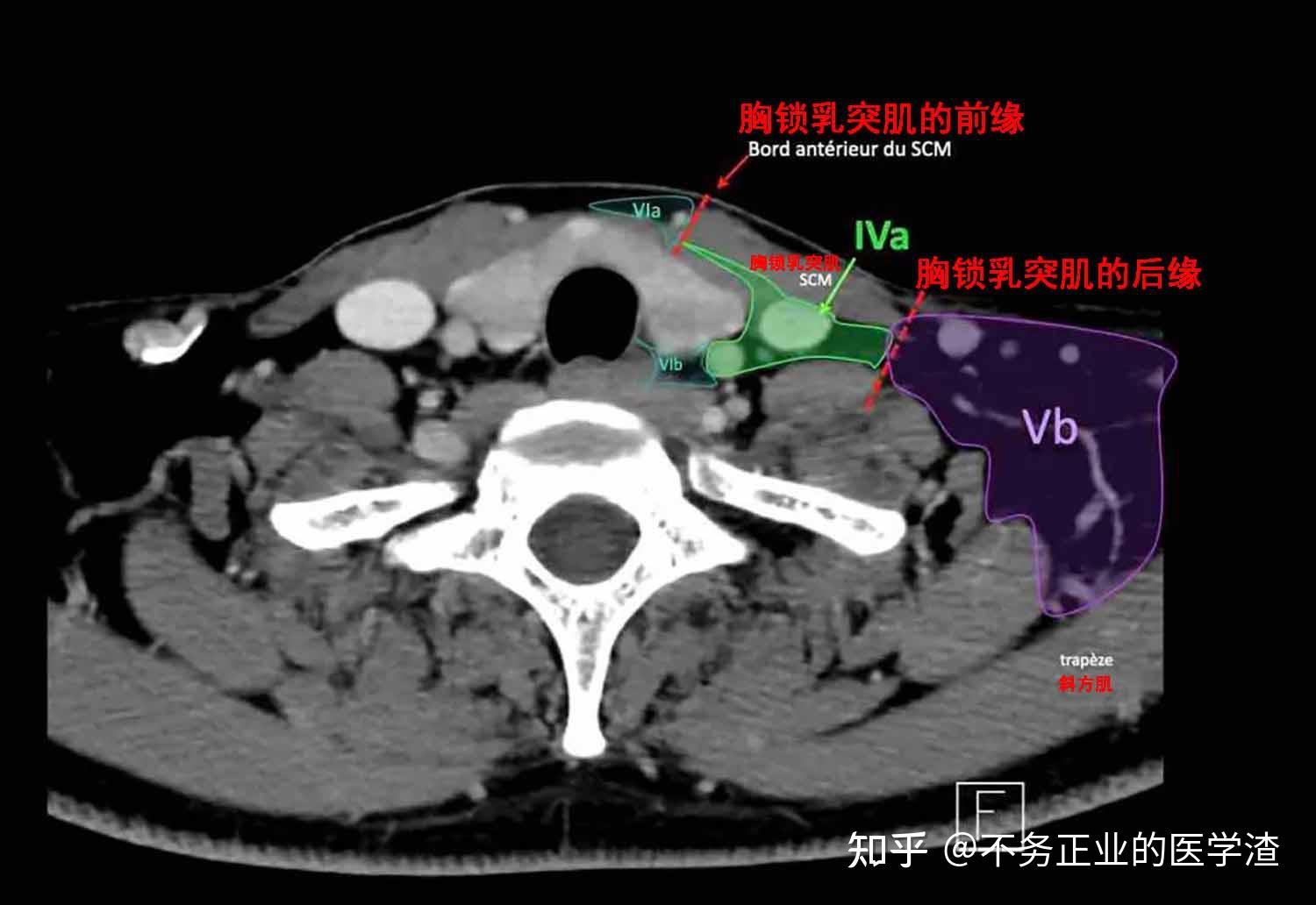 内乳淋巴结ct片图解图片