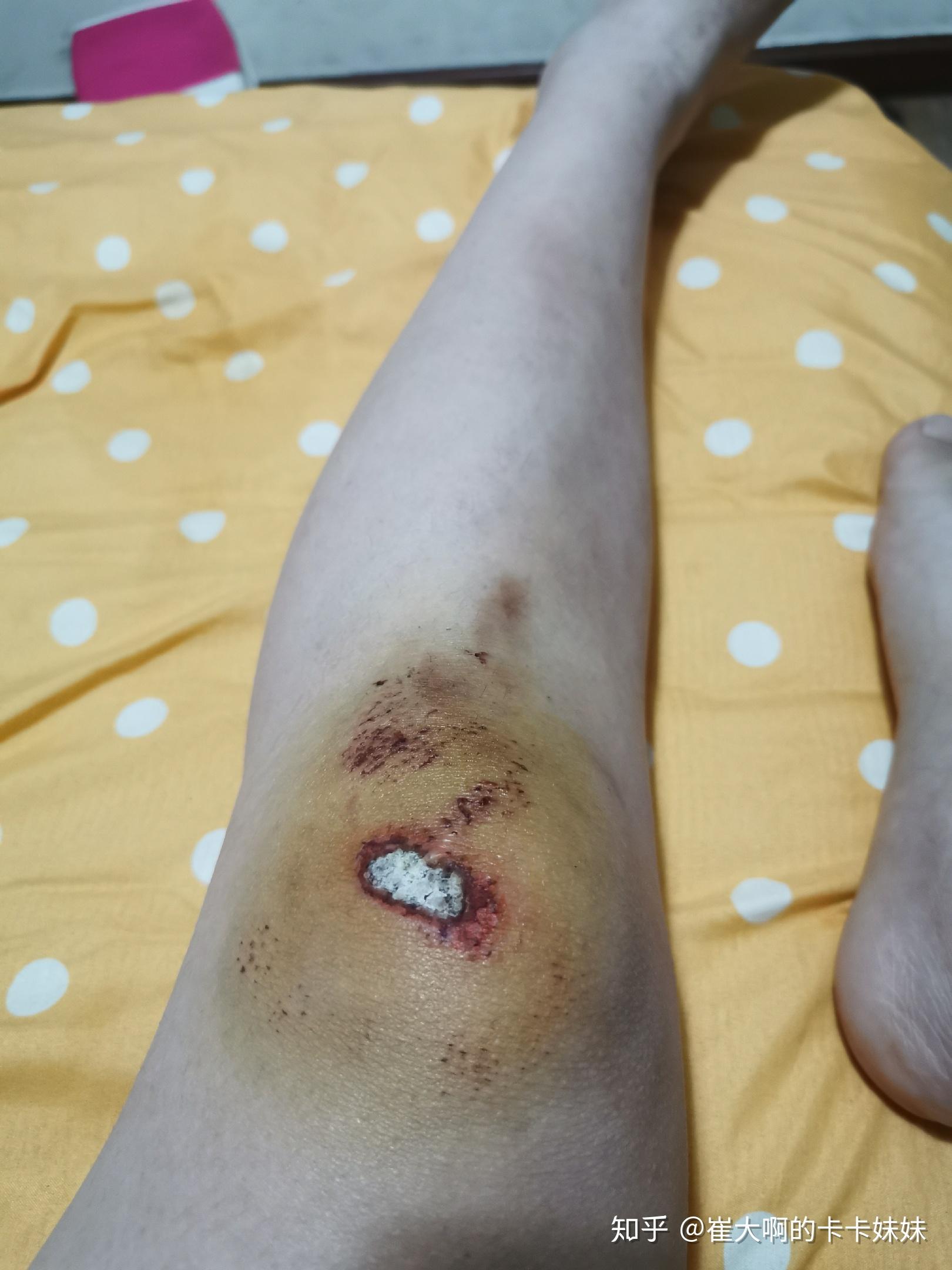 骑车侧翻膝盖摔伤破皮,怎么处理伤口,怎样才能不留疤?