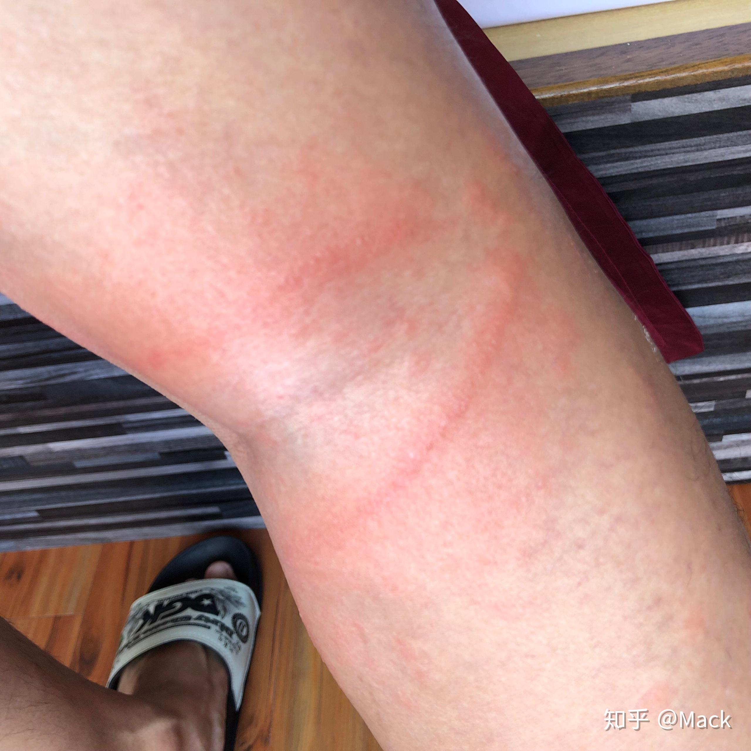 被水母蛰是一种什么体验? - 知乎