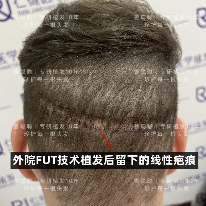 植发会留疤？ - 知乎