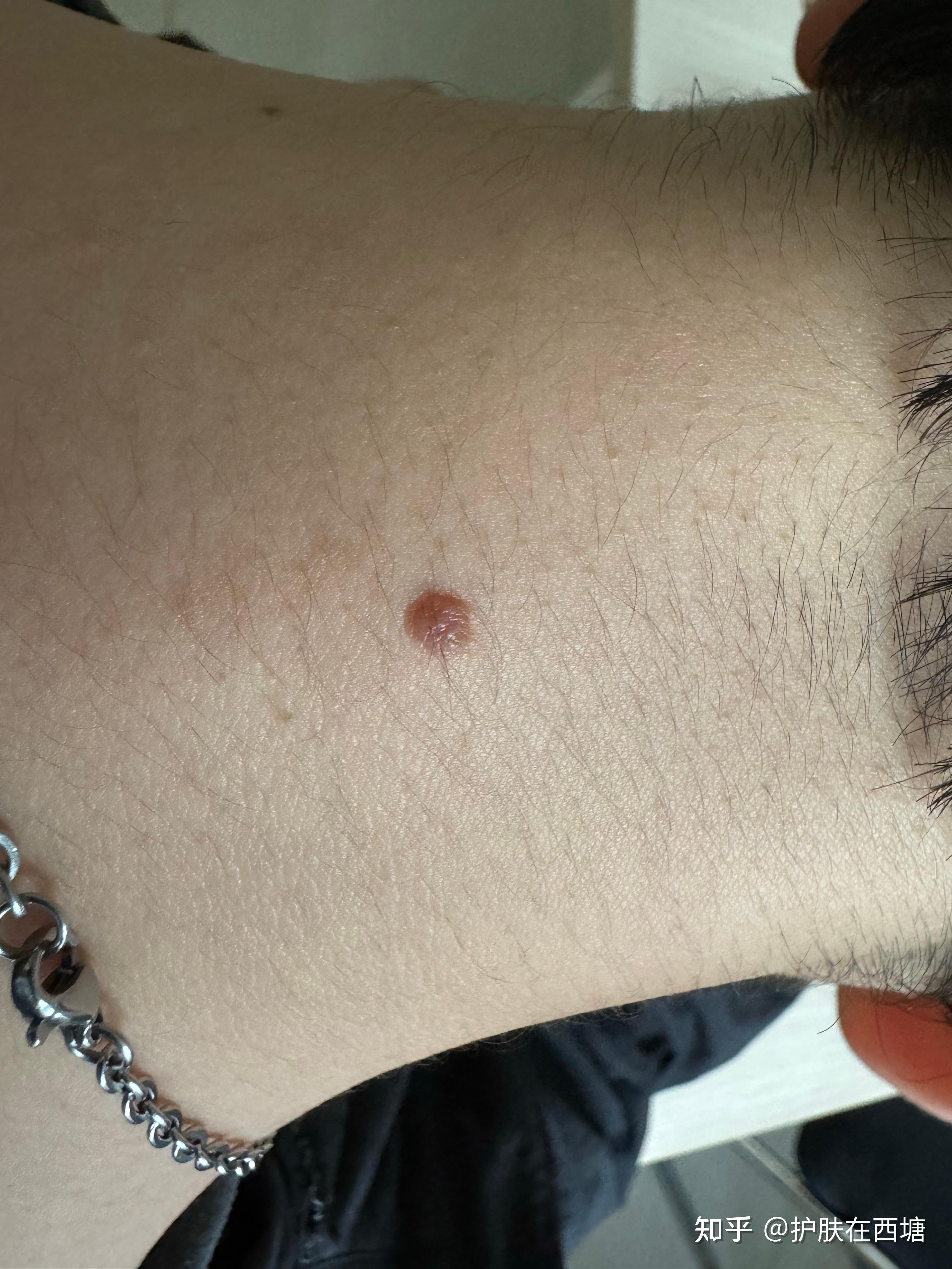 埋线起疙瘩怎么回事啊为什么在线