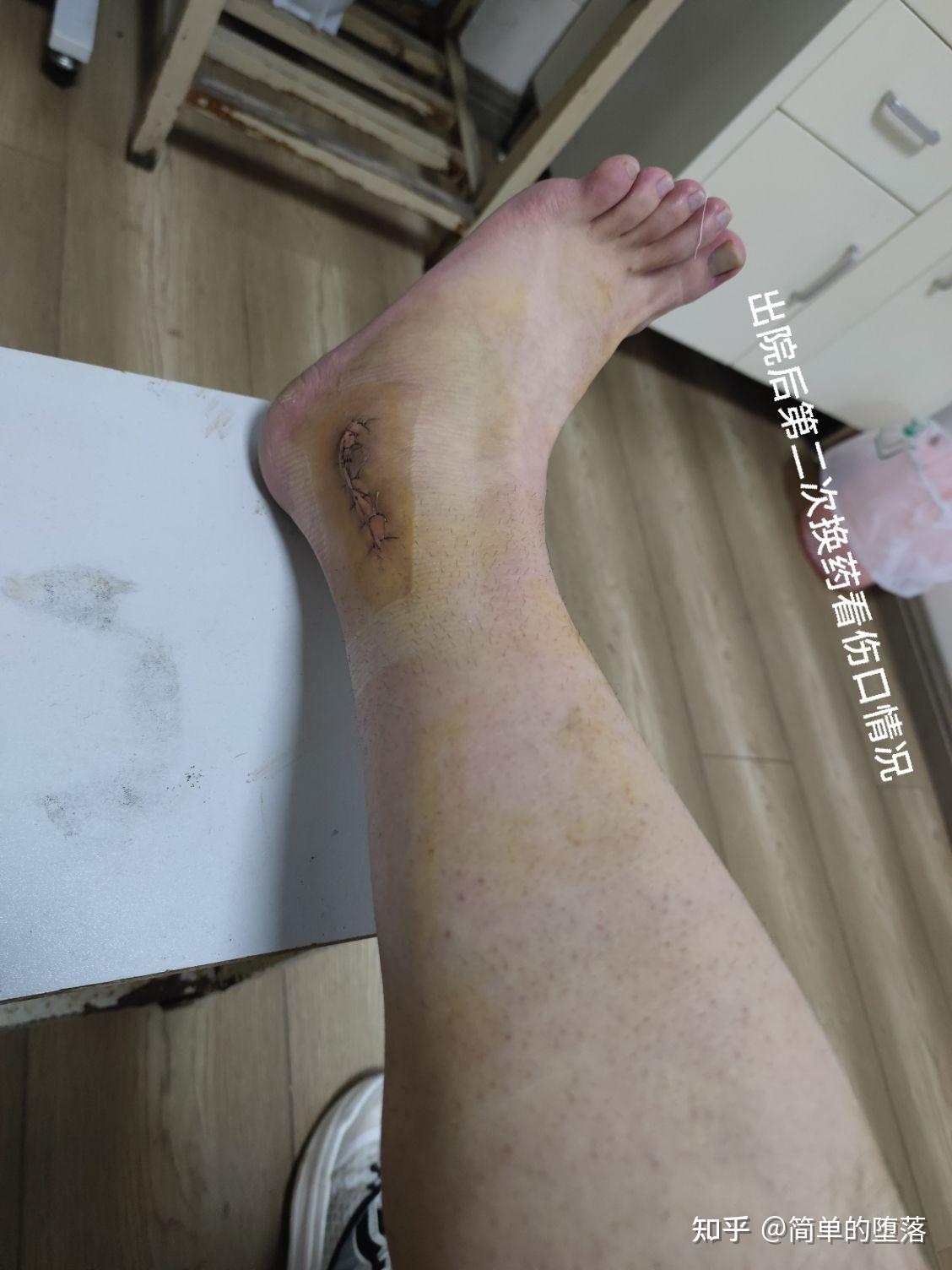 因崴脚运动导致肌腱滑脱从而做手术
