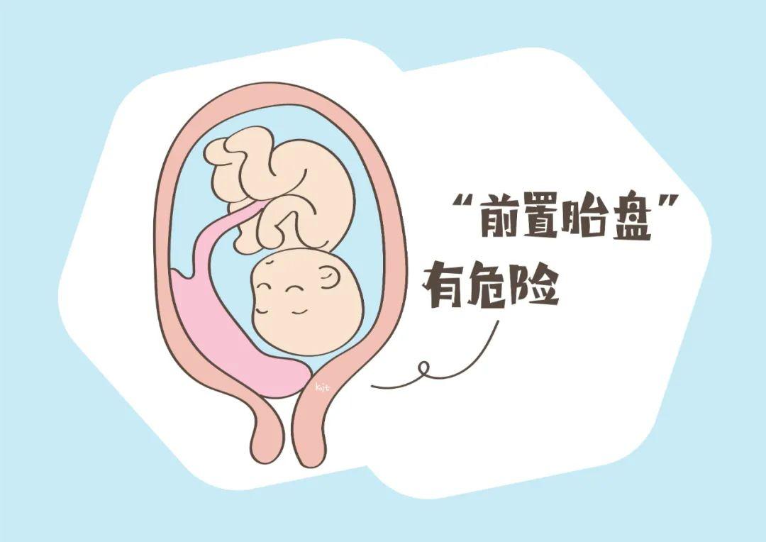 前置胎盘能顺产吗?