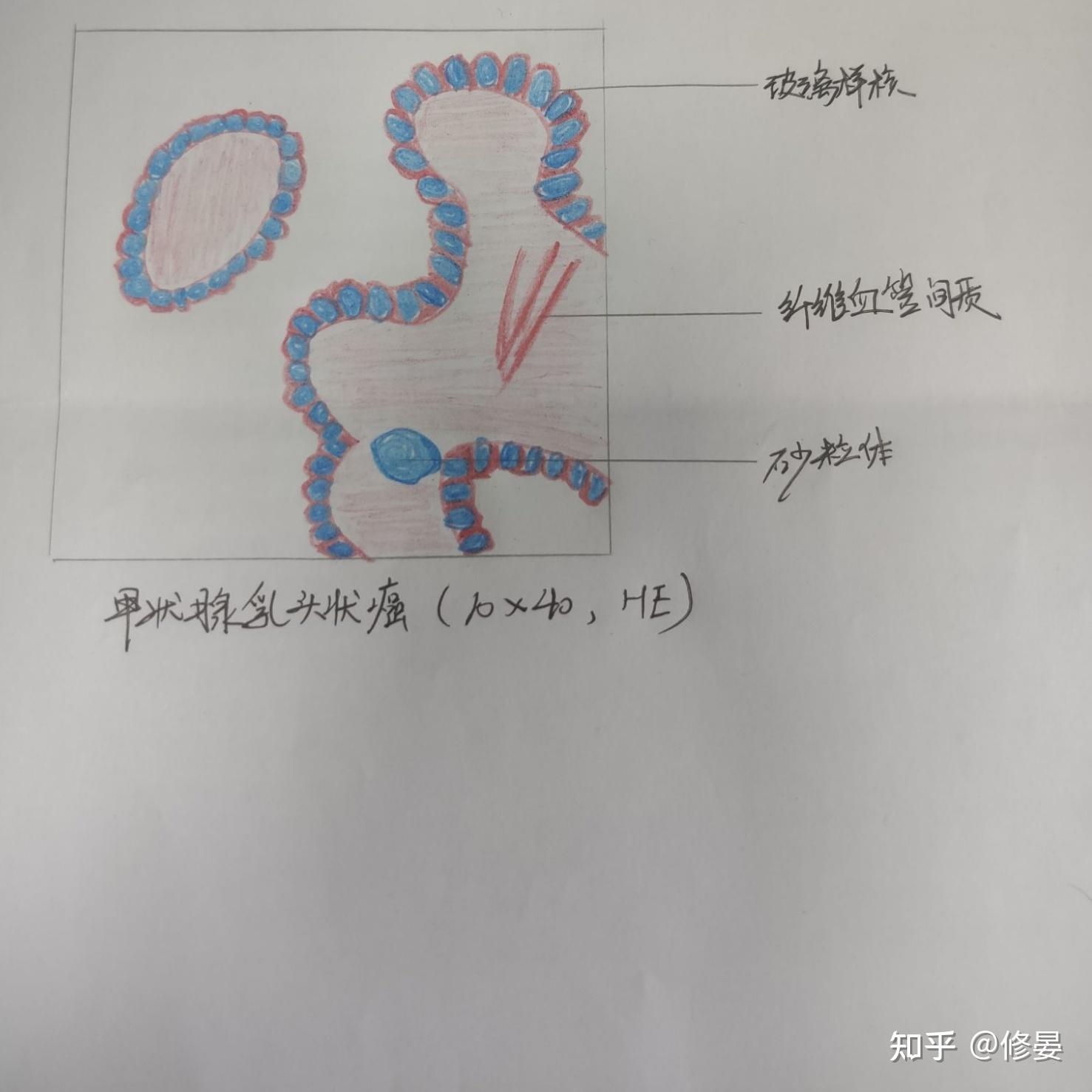 甲状腺乳头状腺癌(第九张画完所有图一起交了,所以没有批改,但是图