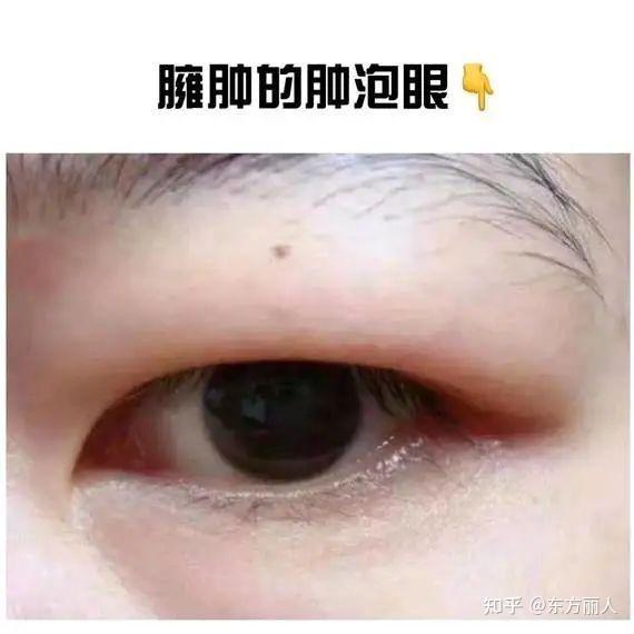 天生肿泡眼？不了解这点之前千万别做双眼皮！ - 知乎