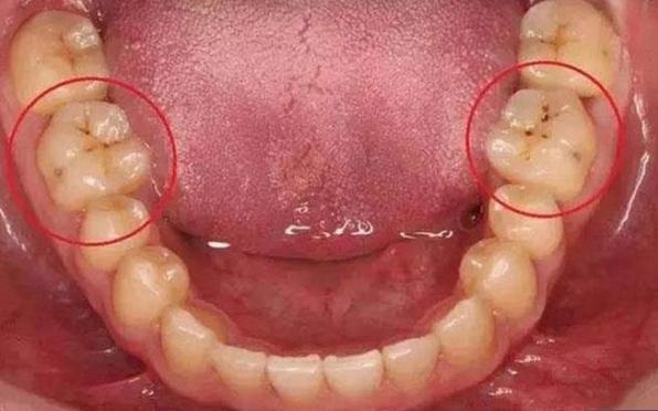 牙齿上的小黑点到底有多可怕?