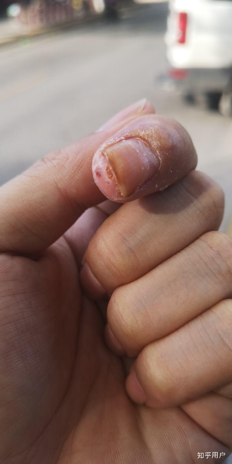 甲下寻常疣做液氮冷冻疼哭了可耐受疼痛真的这么厉害吗还是我太弱了