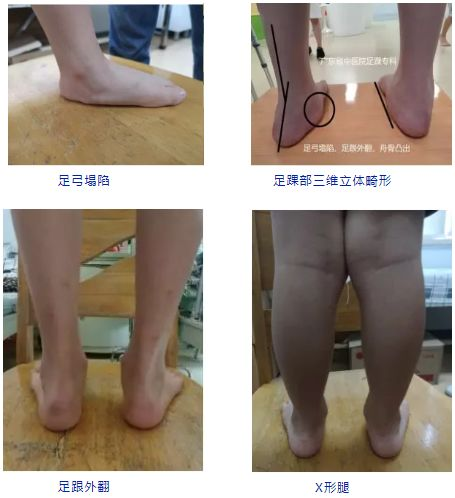 明明很多人脚平但却不知道扁平足的危害