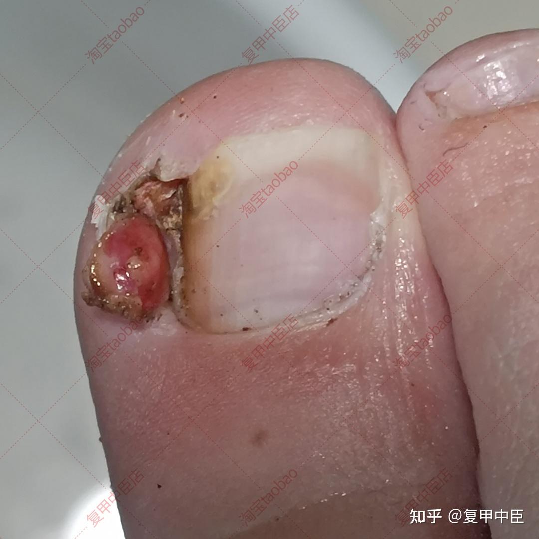 一碰就疼,脚指甲总是往肉里长.学会小妙招,自己处理甲沟炎就能好转