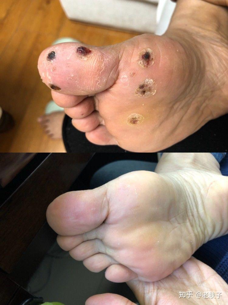 请问我这是跖疣初期吗?用什么药比较好? - 知乎
