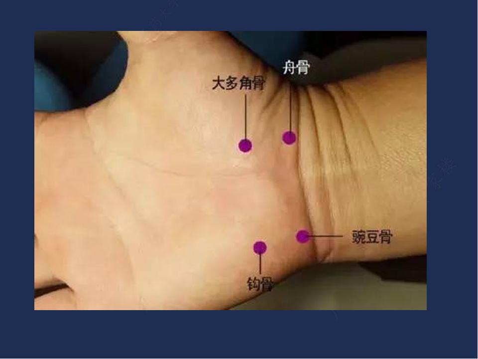 腕管综合征针刀治疗