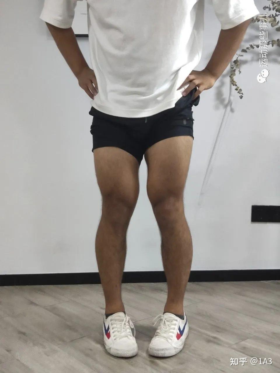 x型腿要怎么矫正? - 知乎