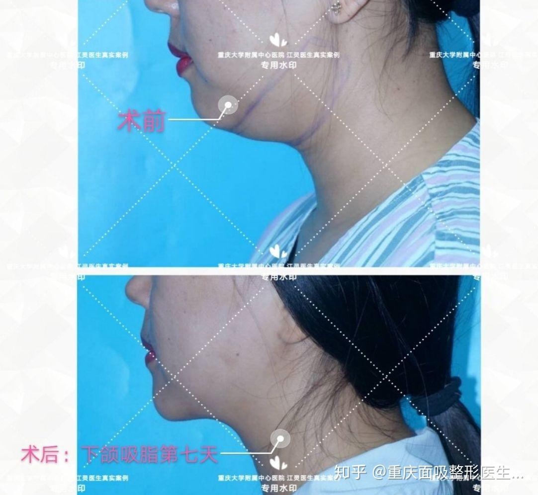 下巴这坨肉怎么才能让它小一点 ? - 知乎