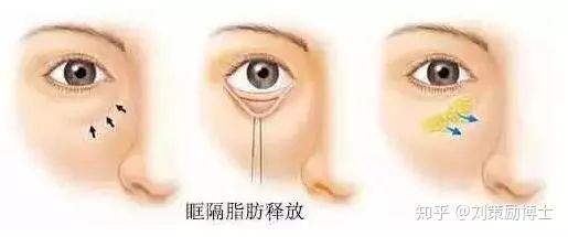 【科普】什么是眶隔释放眼袋整形术？ - 知乎