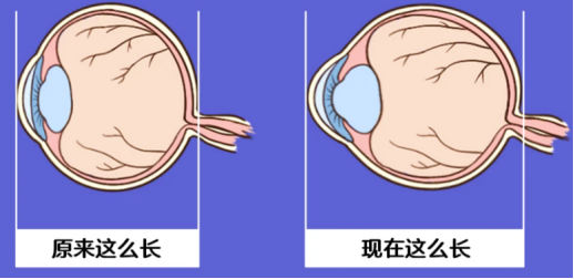 孩子从出生时的远视到之后的近视眼轴经历着这些变化