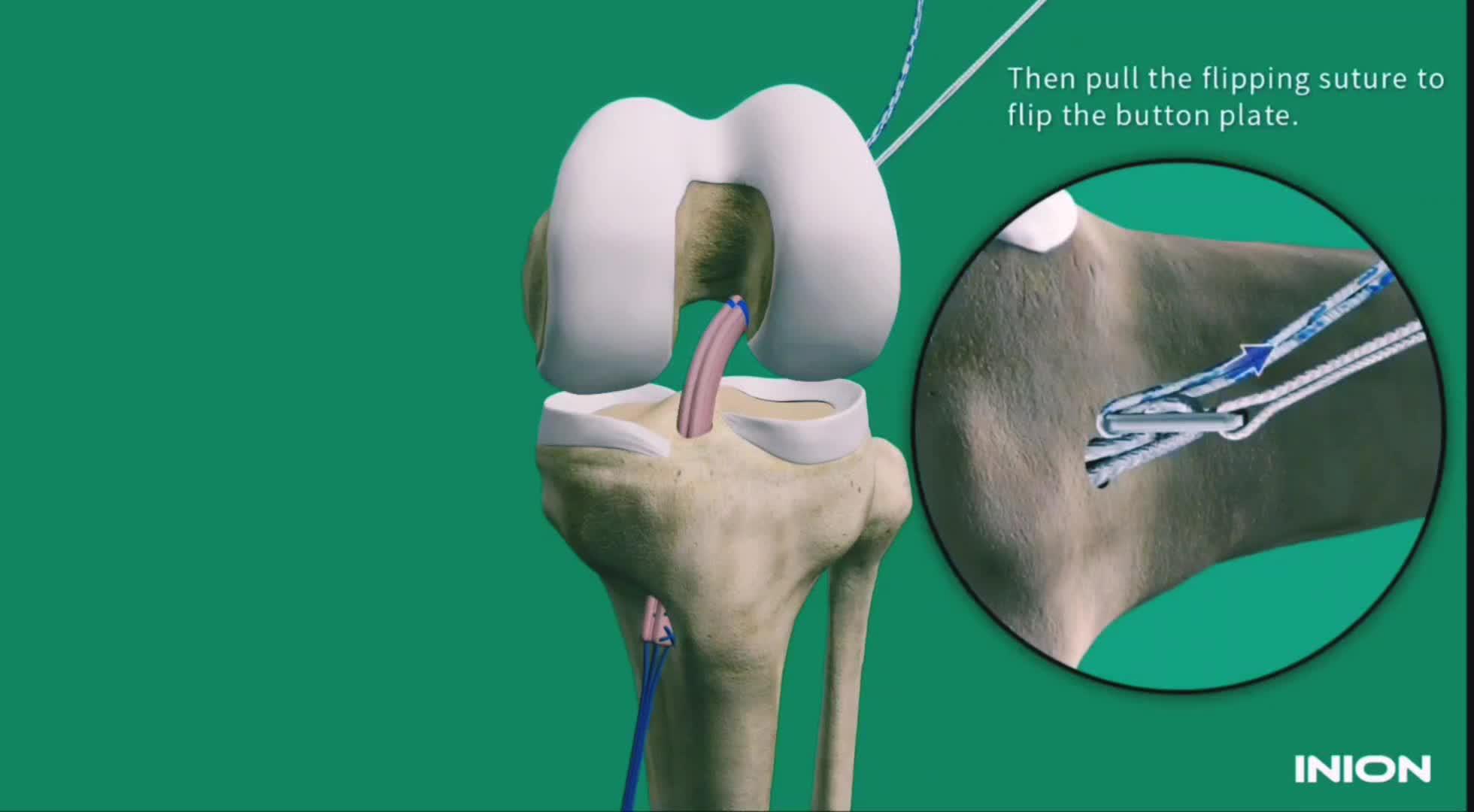 前交叉韧带断裂原理以及重建技术详解
