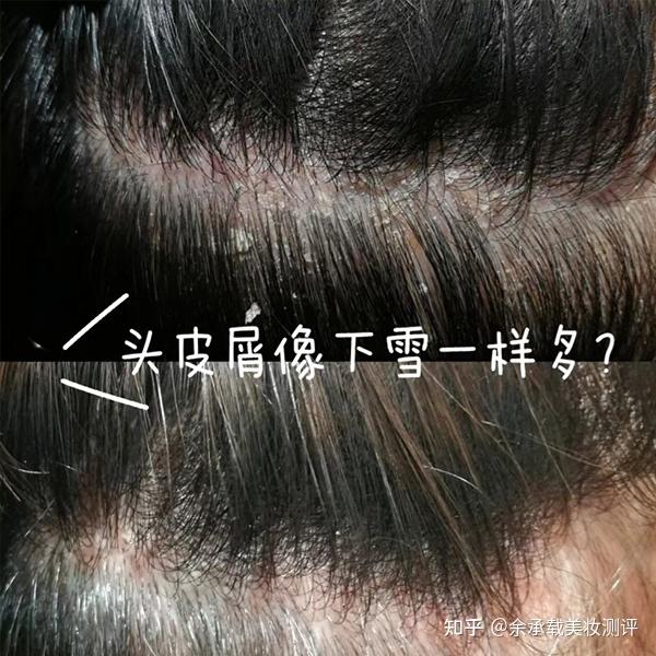 头皮多该用什么洗发水?洗发水去屑止痒排行 - 知乎