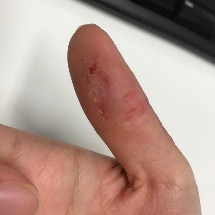 咬手皮是一种怎样的心理? - 知乎