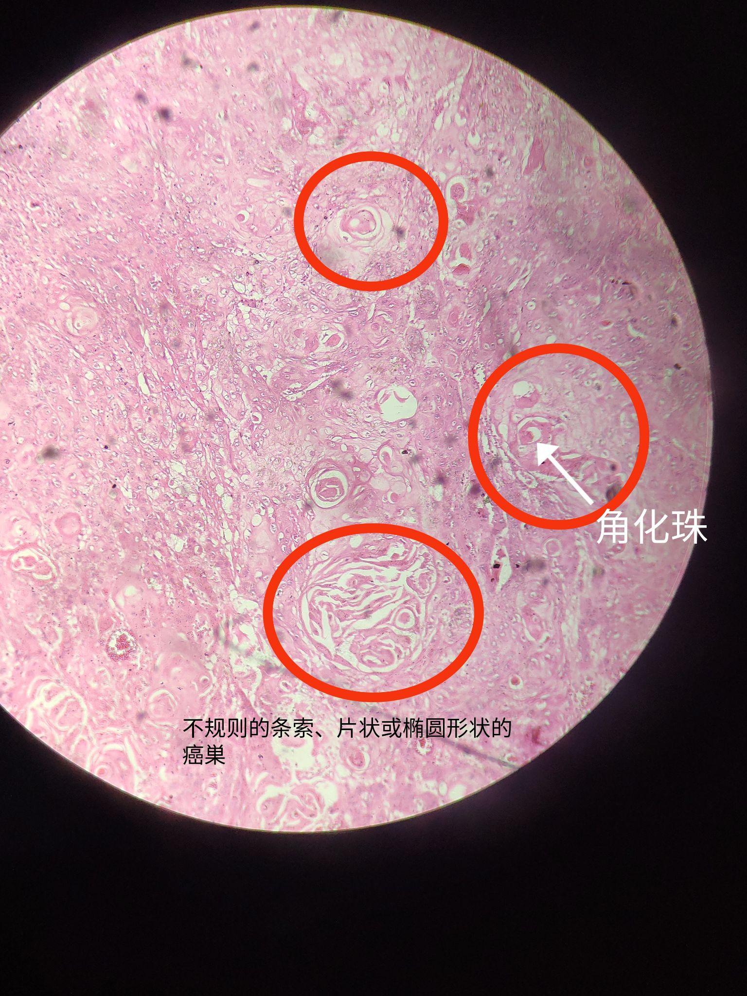 角化珠癌巢图片