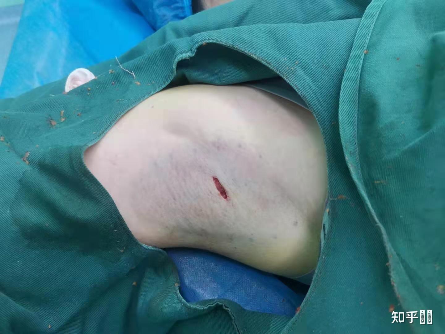 做狐臭手术需要多少钱啊