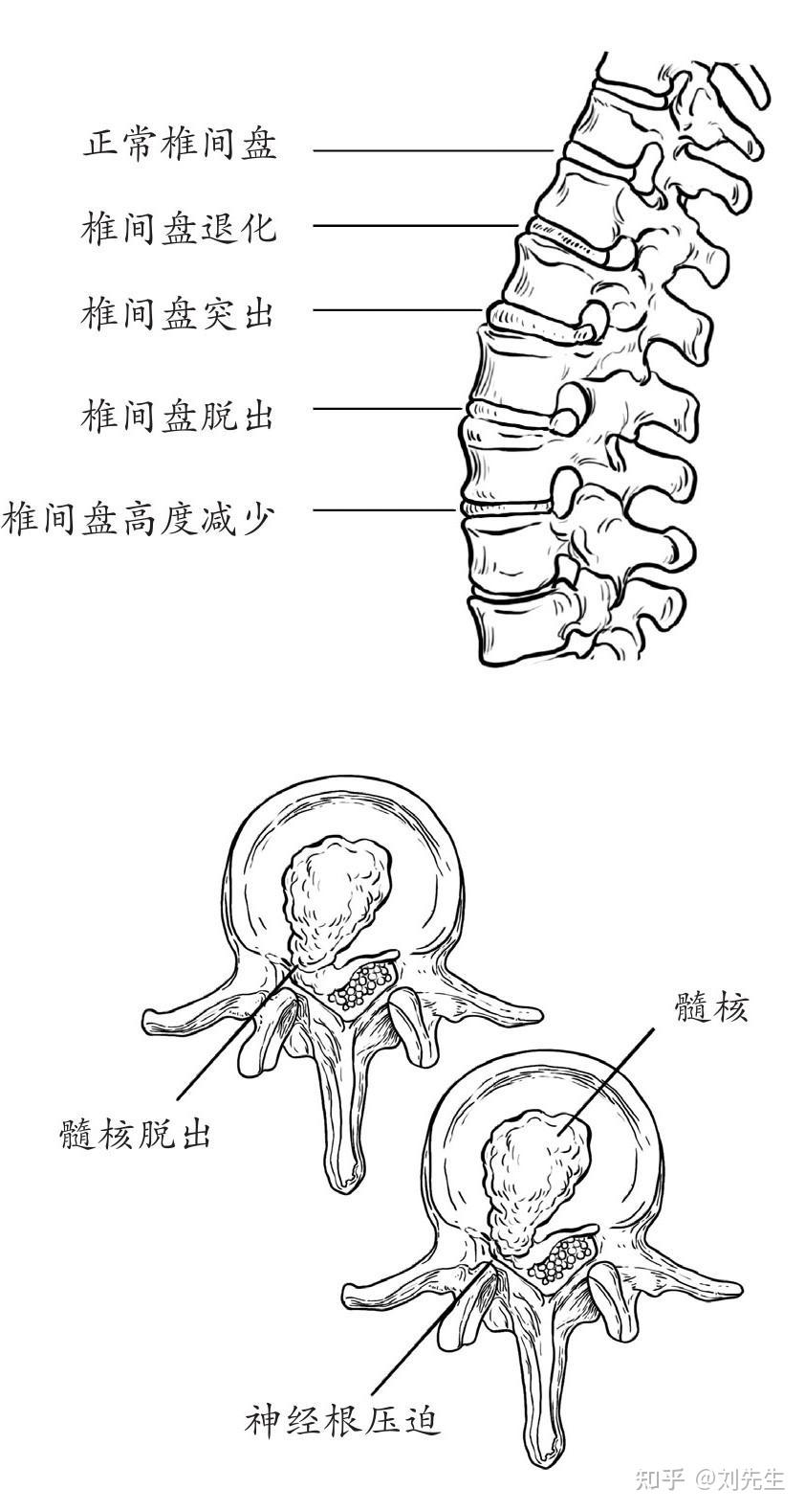 腰椎间盘突出症定义、病因、临床表现、诱发因素 知乎