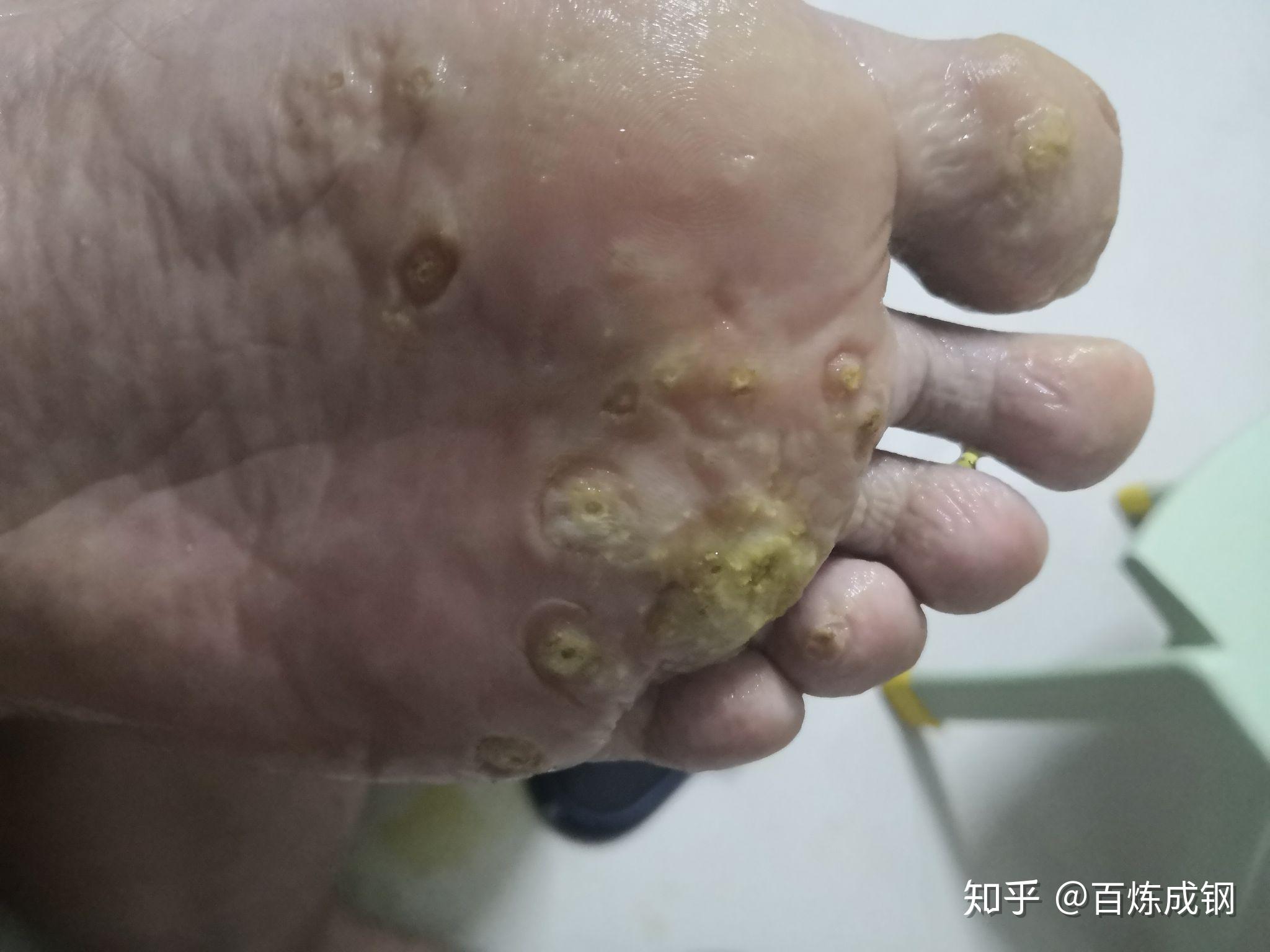 跖疣治疗第24天 - 知乎