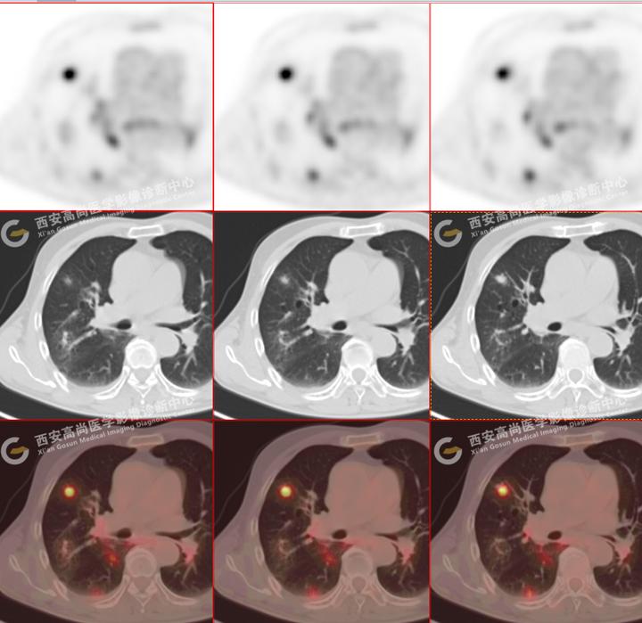 81岁男性,多发肺结节病例:重症感染 | 惠普尔养障体肺炎